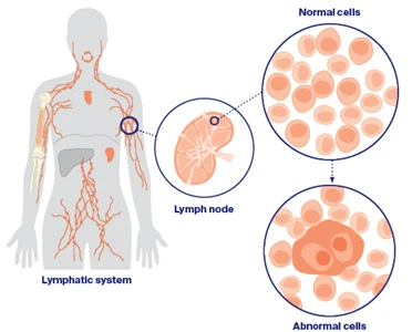 Non-Hodgkin diseased cell