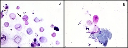 Cryptococcal infection