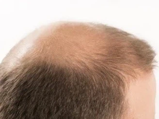 Does pyrilutamide stop hair loss Does pyrilutamide stop hair loss